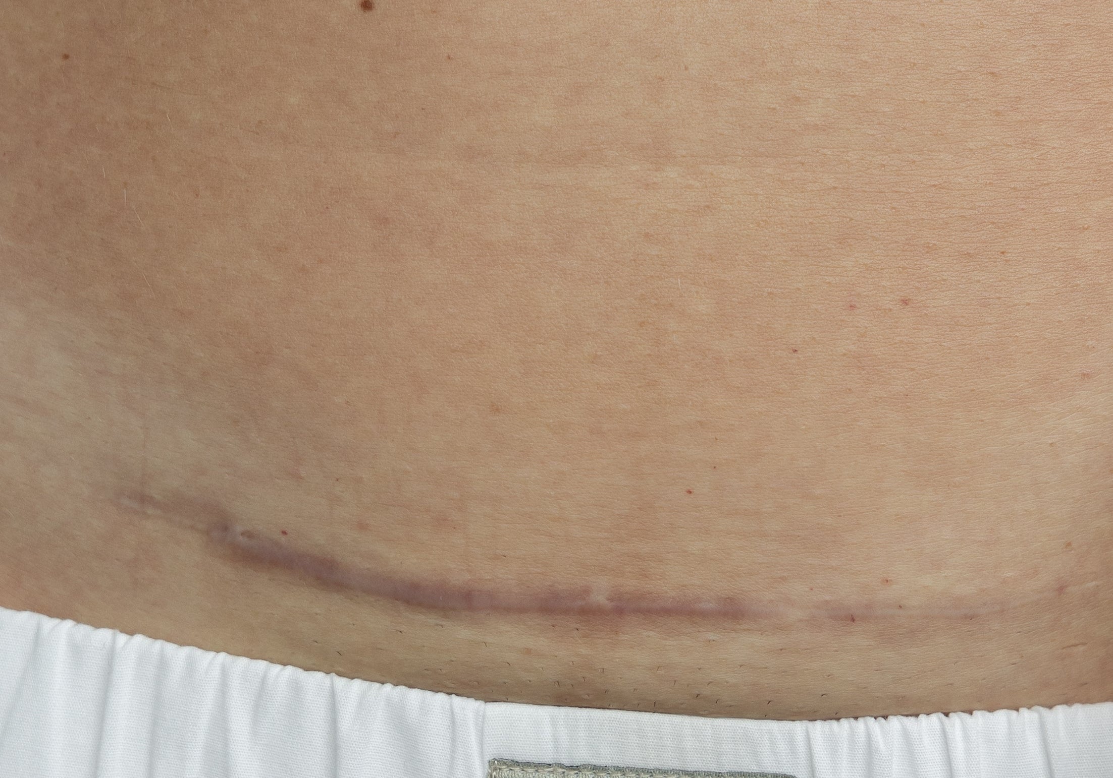Everything You Need to Know About Your C-Section Scar