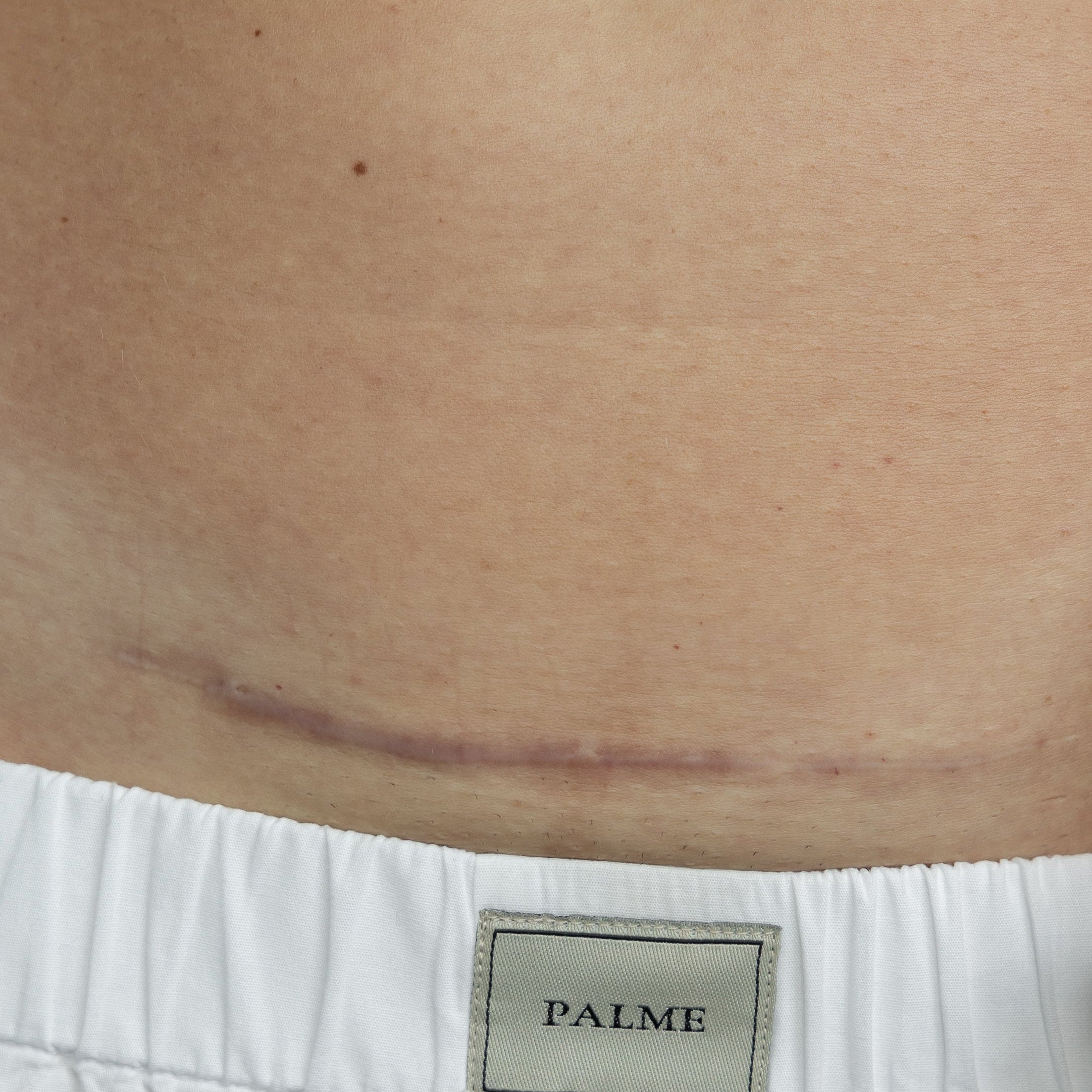 Everything You Need to Know About Your C-Section Scar
