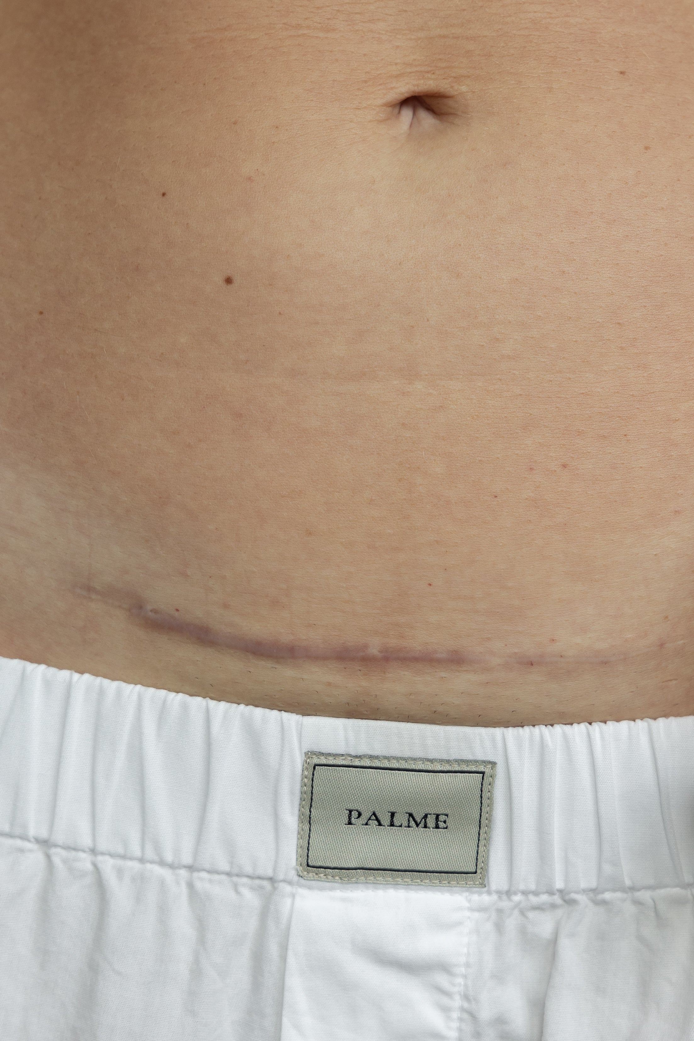 Everything You Need to Know About Your C-Section Scar